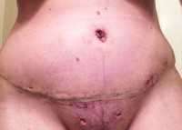 8 days tummy tuck post op. Drains removed. Extremely swollen