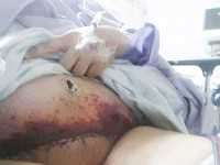 Bad blood circulation along the incision in pubic area