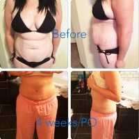 Before and after tummy tuck procedure