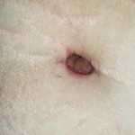 Belly button tummy tuck