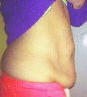 Pregnancy after tummy tuck surgery photos