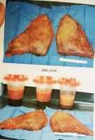 Removed skin after tummy tuck